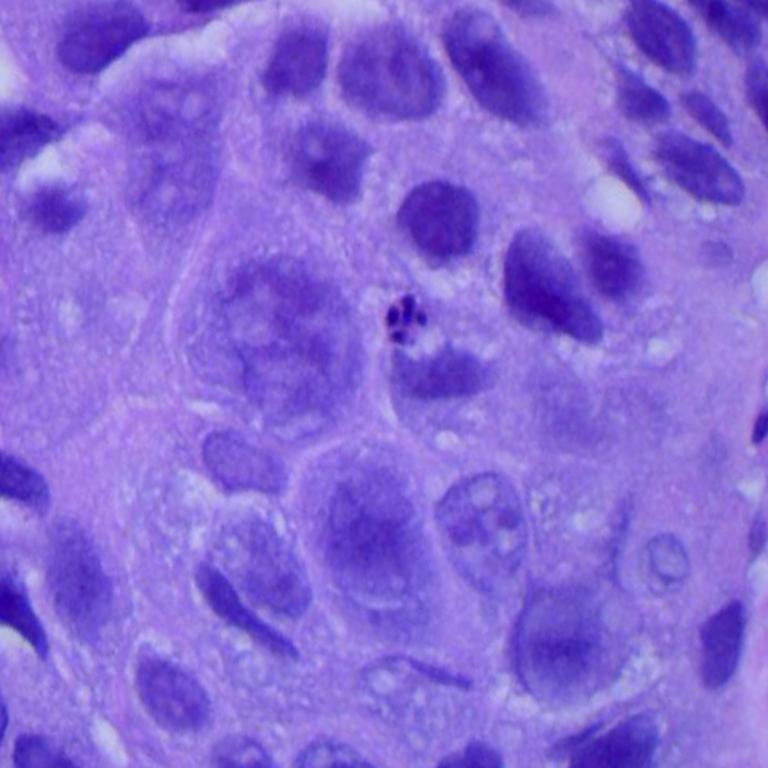 该数据集包含3类15000张组织病理学图像。所有图像大小为768 x 768像素，并为jpeg文件格式。这些图像来自符合hipaa标准的原始样本和经过验证的来源，包括750张肺组织图像(250张良性肺组织，250张肺腺癌和250张肺鳞状细胞癌)，使用Augmentor包增加到15,000张，数据集中有3个类别，每个类别有5000张图