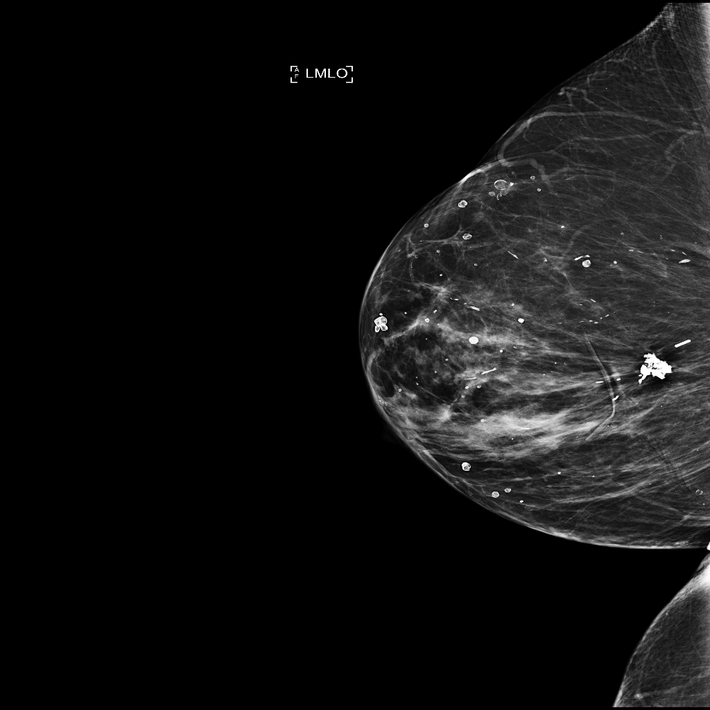 1024例乳腺癌X射线图像数据集，