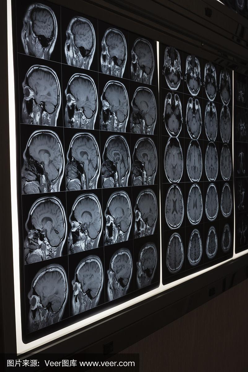 阿尔茨海默病MRI图像数据，用于老年性痴呆的诊断