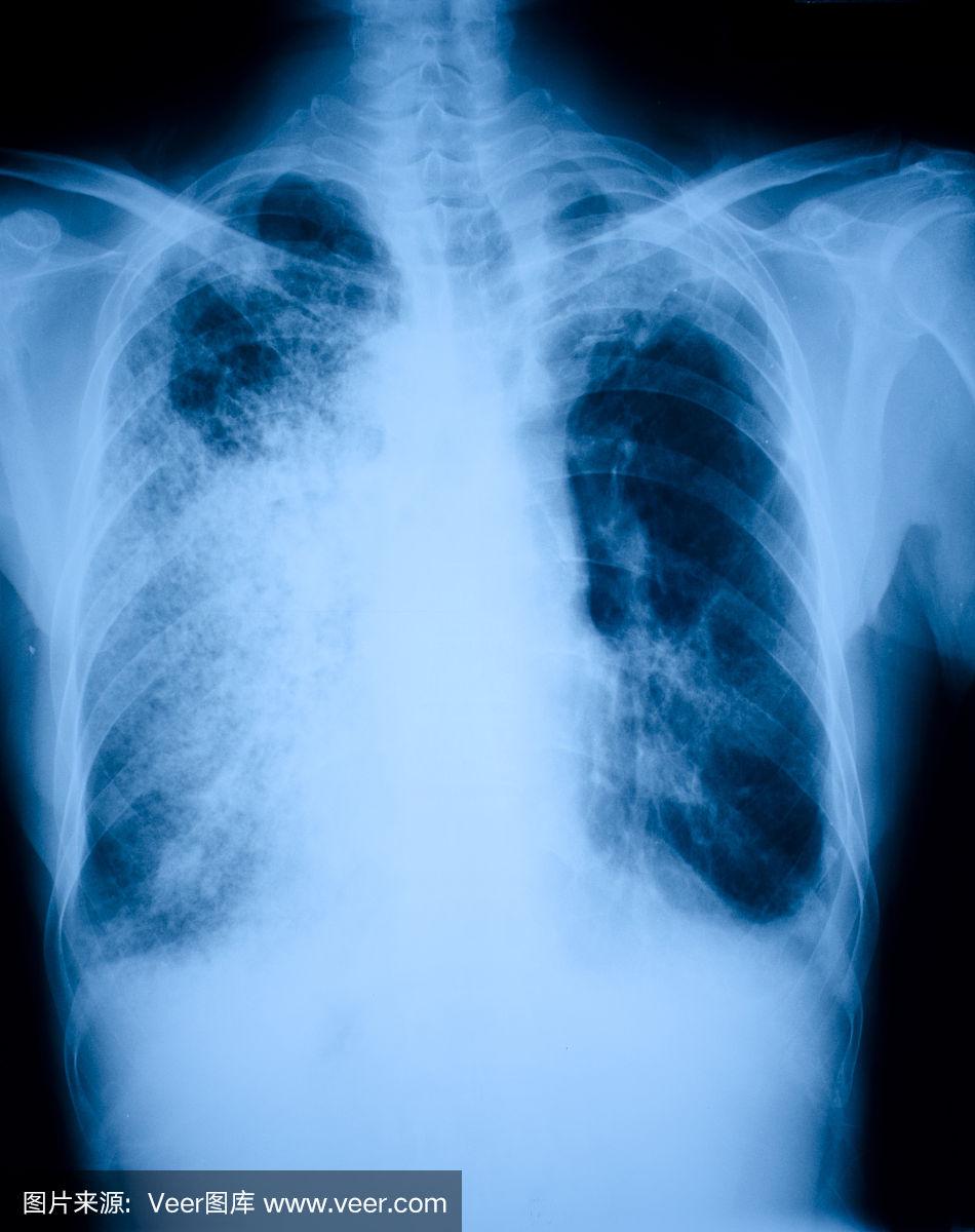 肺炎胸部X线数据集的医学图像数据集