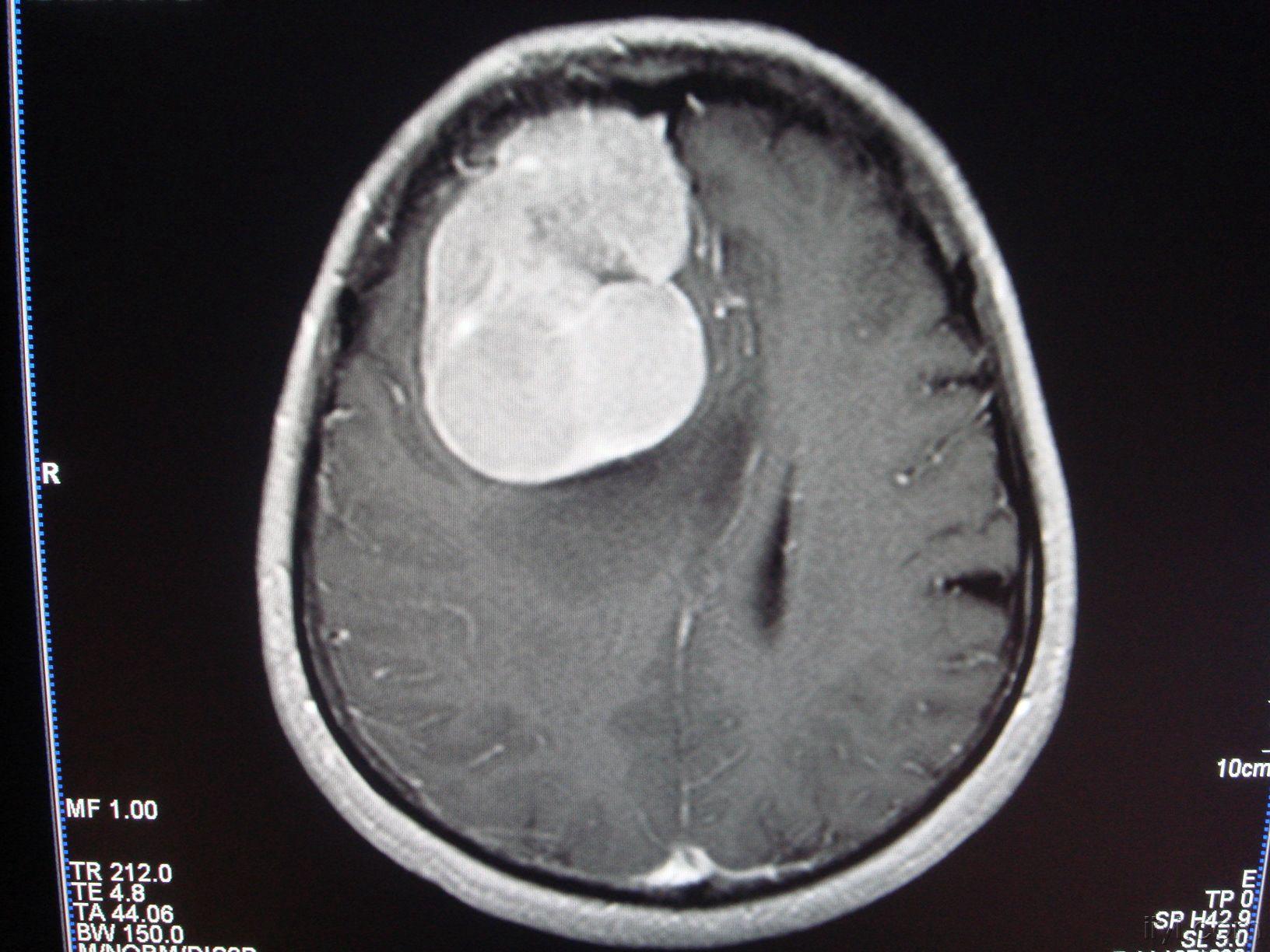 基于灰度归一化的脑肿瘤图像数据集