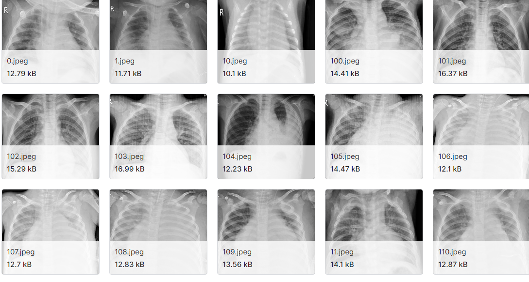 2019冠状病毒病探测X射线数据集