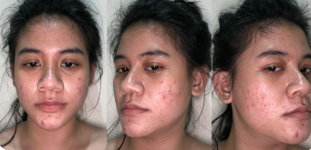 人类面部皮肤缺陷数据集