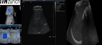 肝脏的二维超声序列数据集