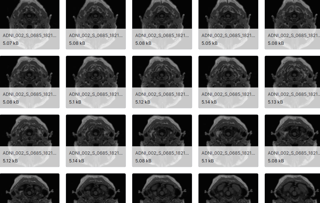 用于阿尔茨海默病检测的数据集
