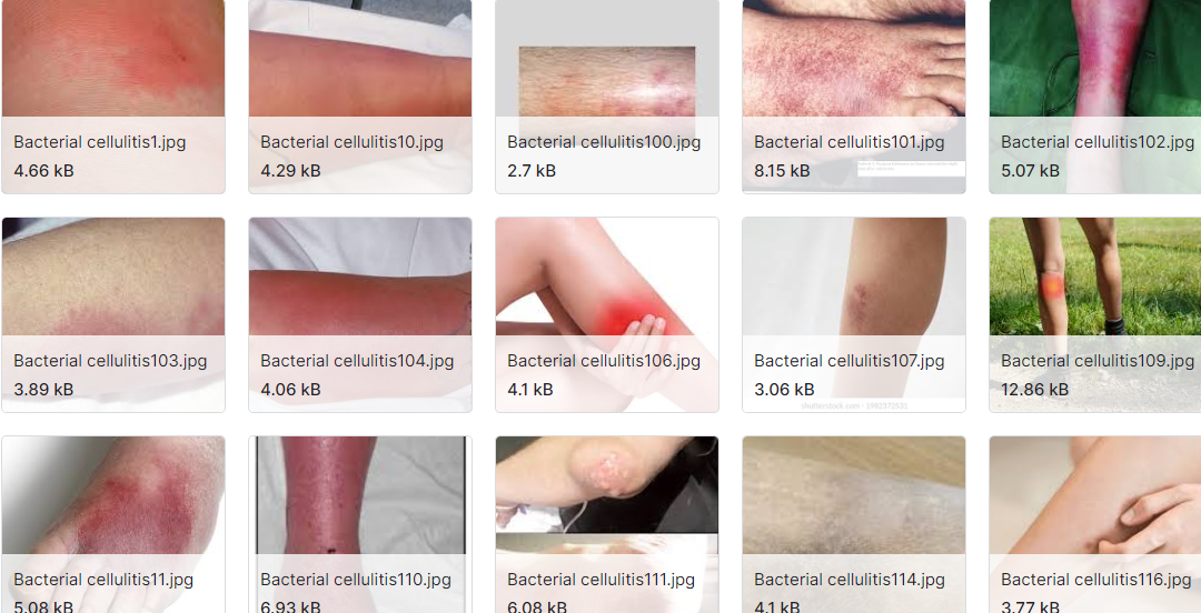 莱姆病皮疹数据集