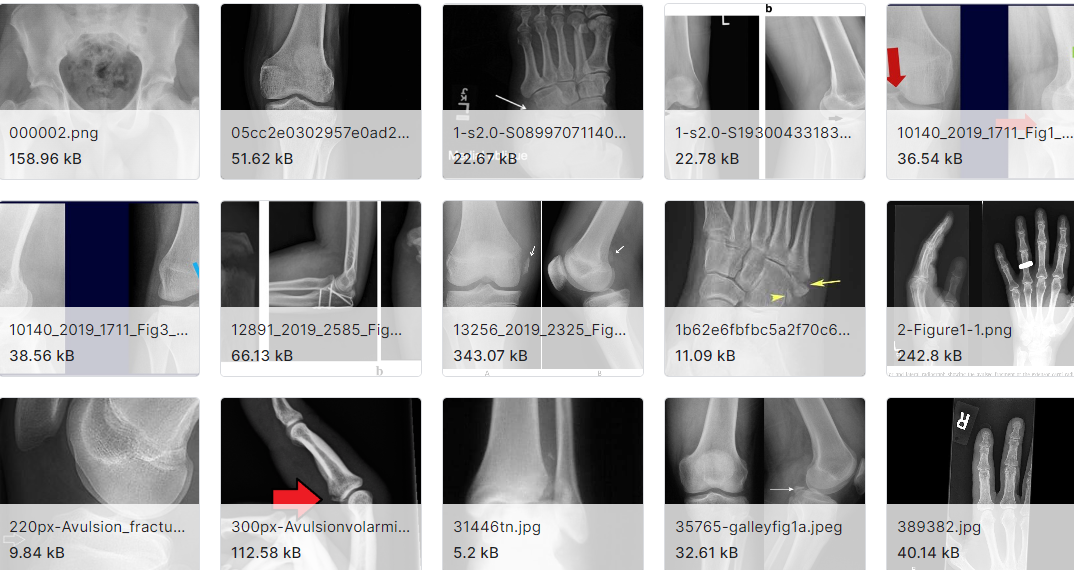 12种不同类型的骨折图片数据集