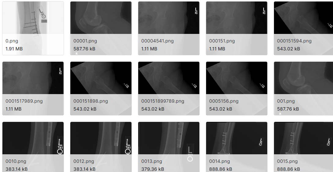 骨折多区域X线图片资料数据集