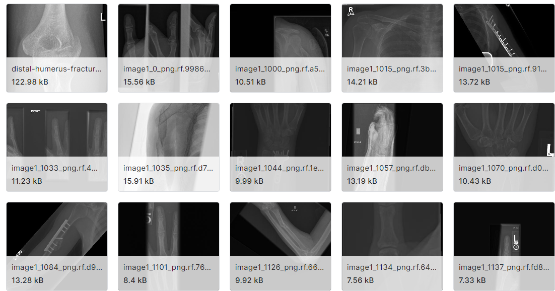骨折检测计算机视觉图片数据集