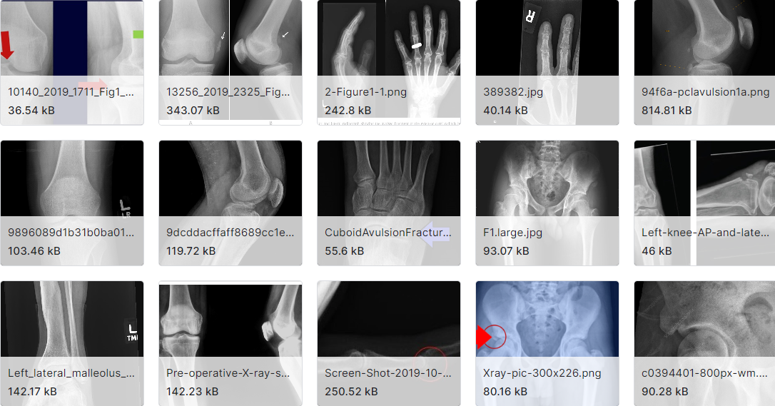 骨折裂缝分型图片数据集
