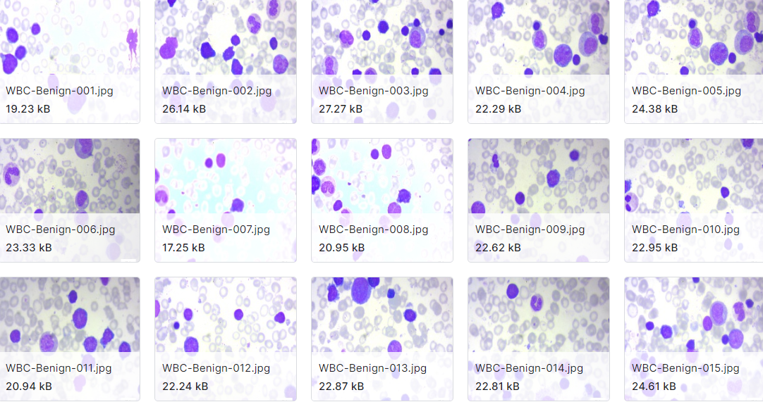 急性淋巴细胞白血病图像数据集
