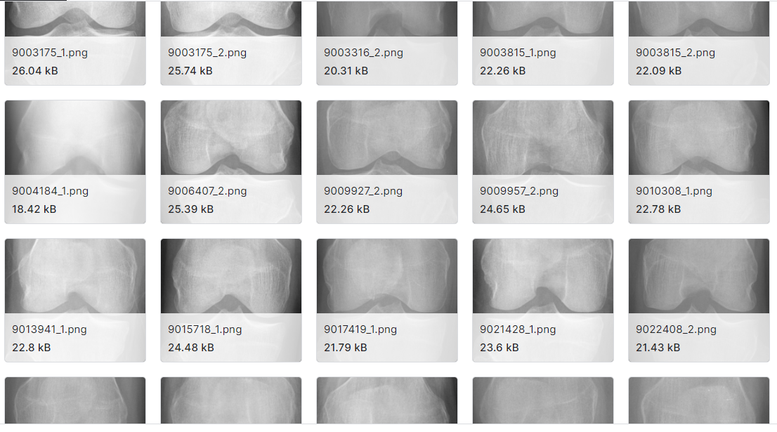 膝关节骨性关节炎严重度分级数据集