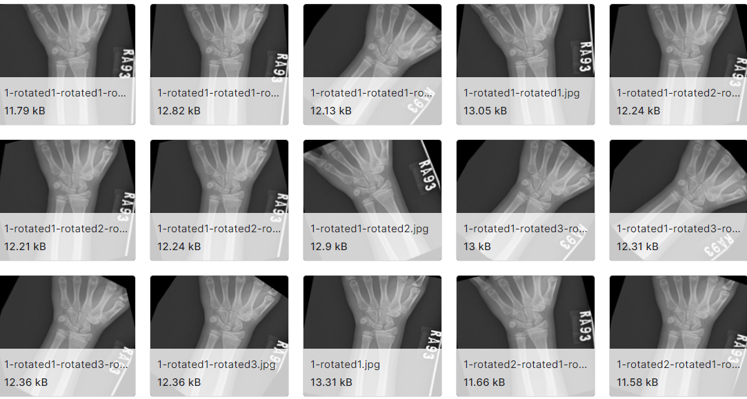 相关的骨折图片数据集