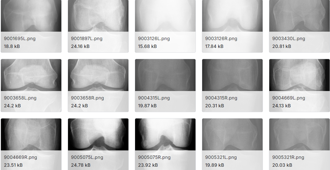骨关节炎预测图片数据集