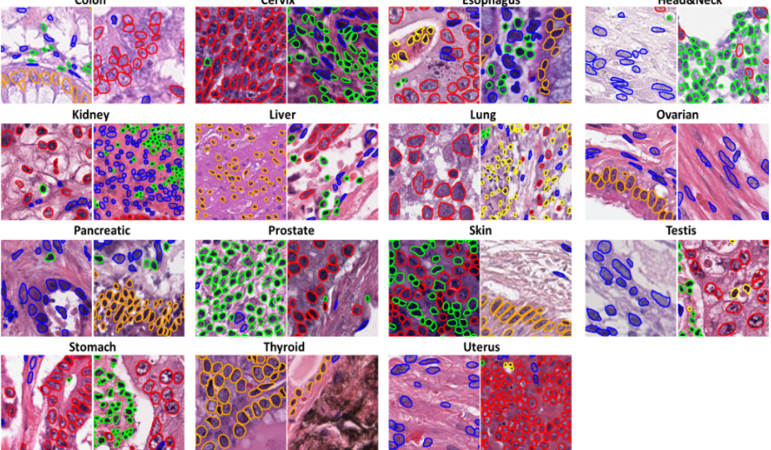 肿瘤实例分割与分类图片数据集
