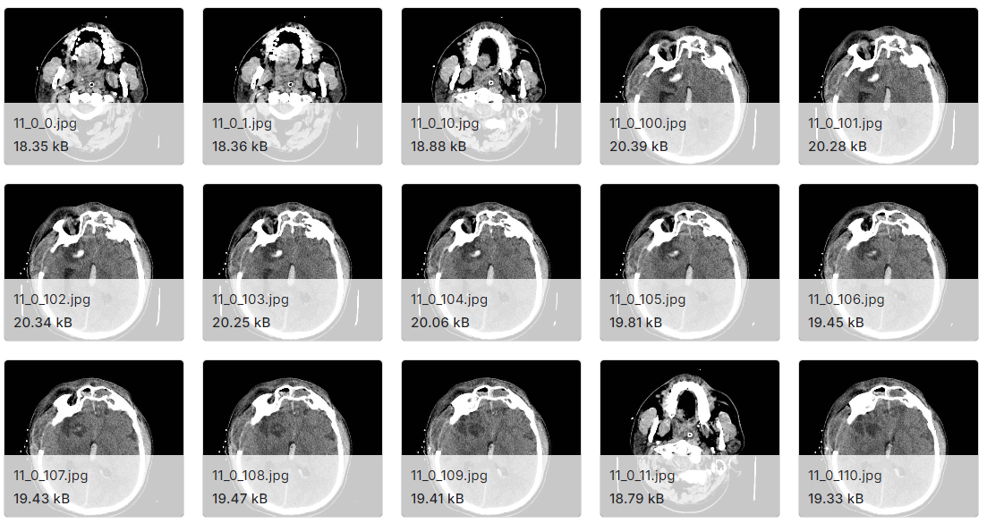 正常与出血性CT扫描图像数据集