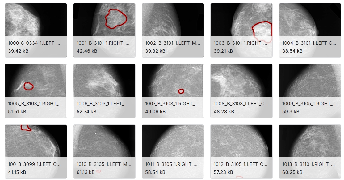 DDSM(数字乳腺筛查图像数据集）