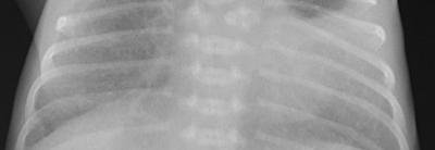 胸部X光肺炎检测数据集